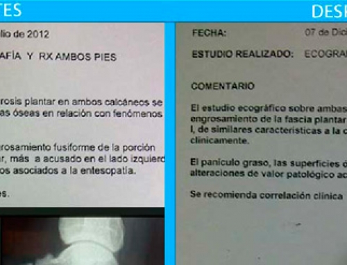 Fascitis plantar bilateral con espolón calcáneo